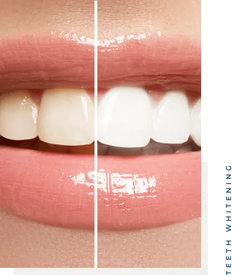 Teeth Whitening 2