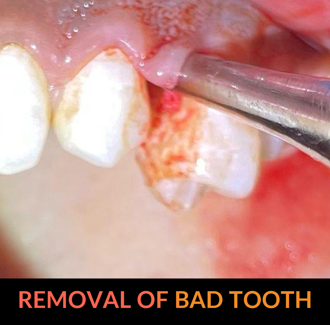 Removal of bad tooth